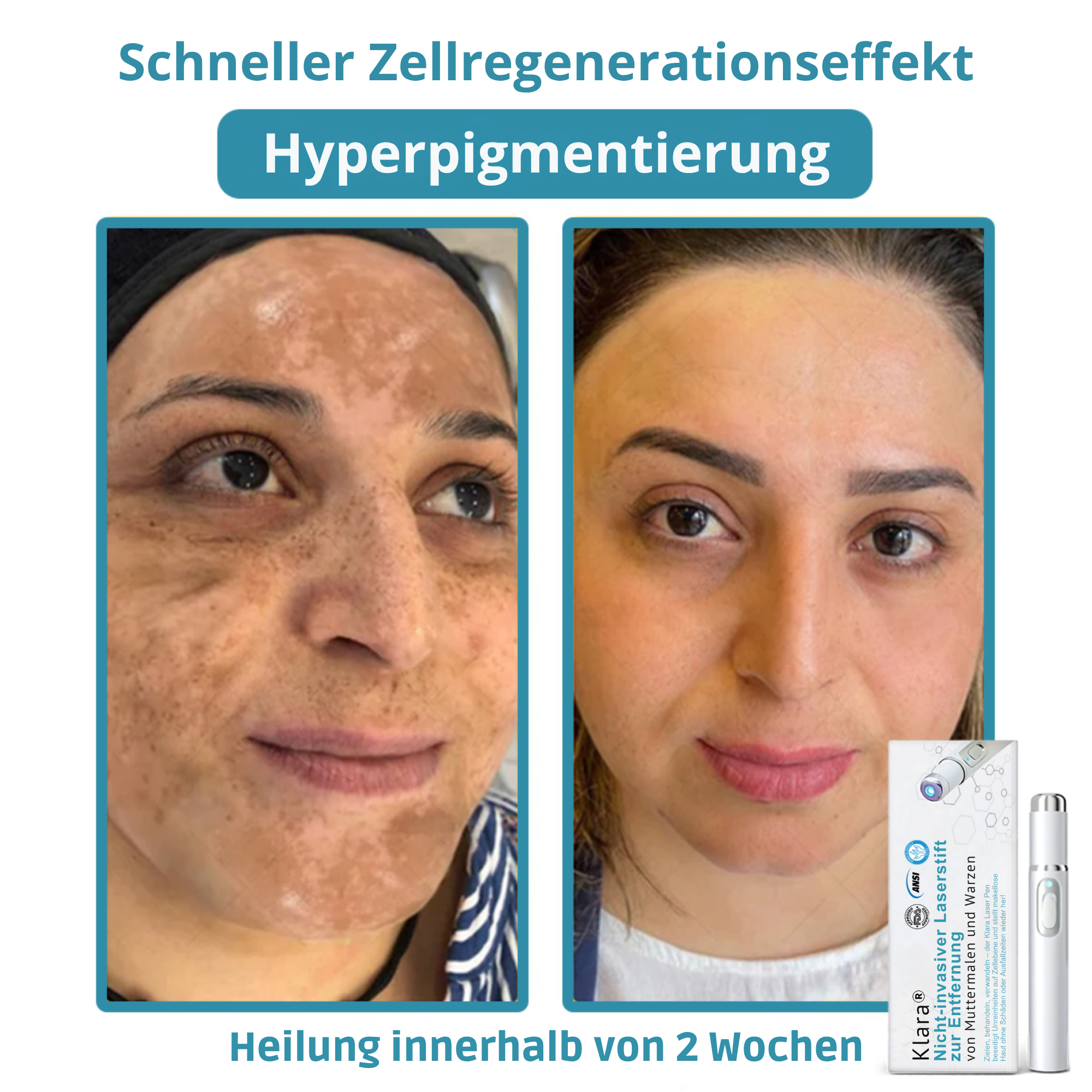 Klara® Schmerzfreier Laserstift zur Entfernung von Muttermalen und Warzen – Promax Edition