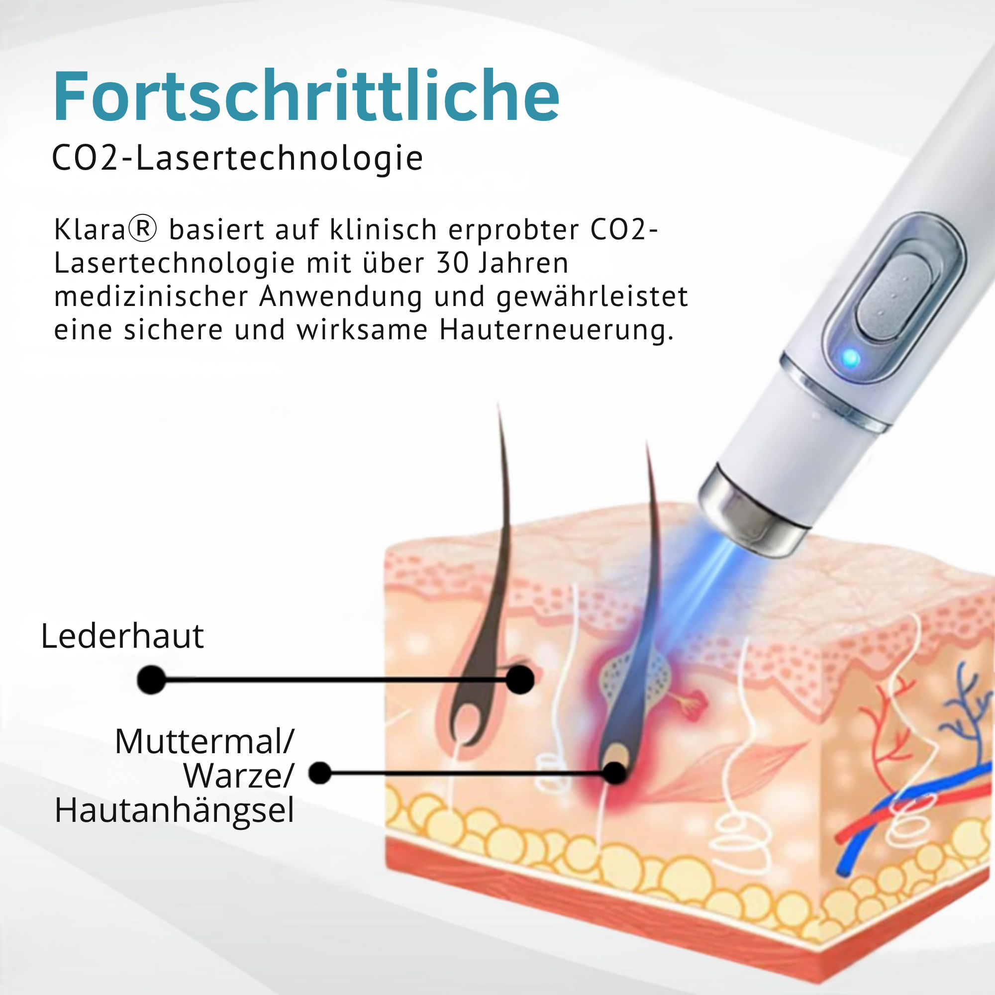 Klara® Schmerzfreier Laserstift zur Entfernung von Muttermalen und Warzen – Promax Edition