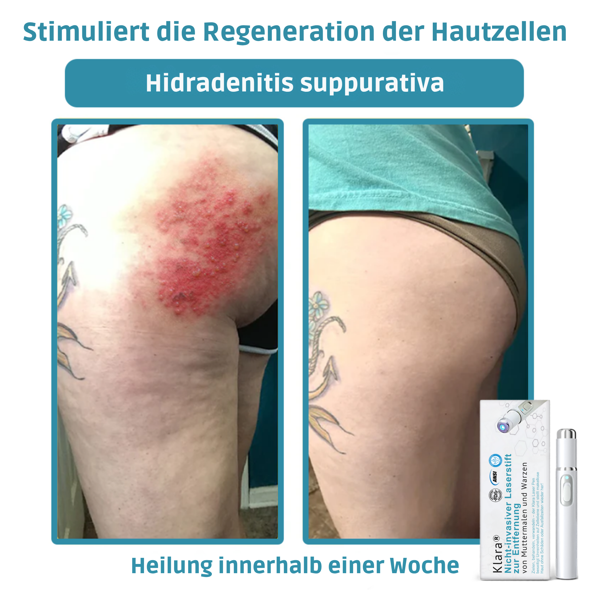 Klara® Schmerzfreier Laserstift zur Entfernung von Muttermalen und Warzen – Promax Edition