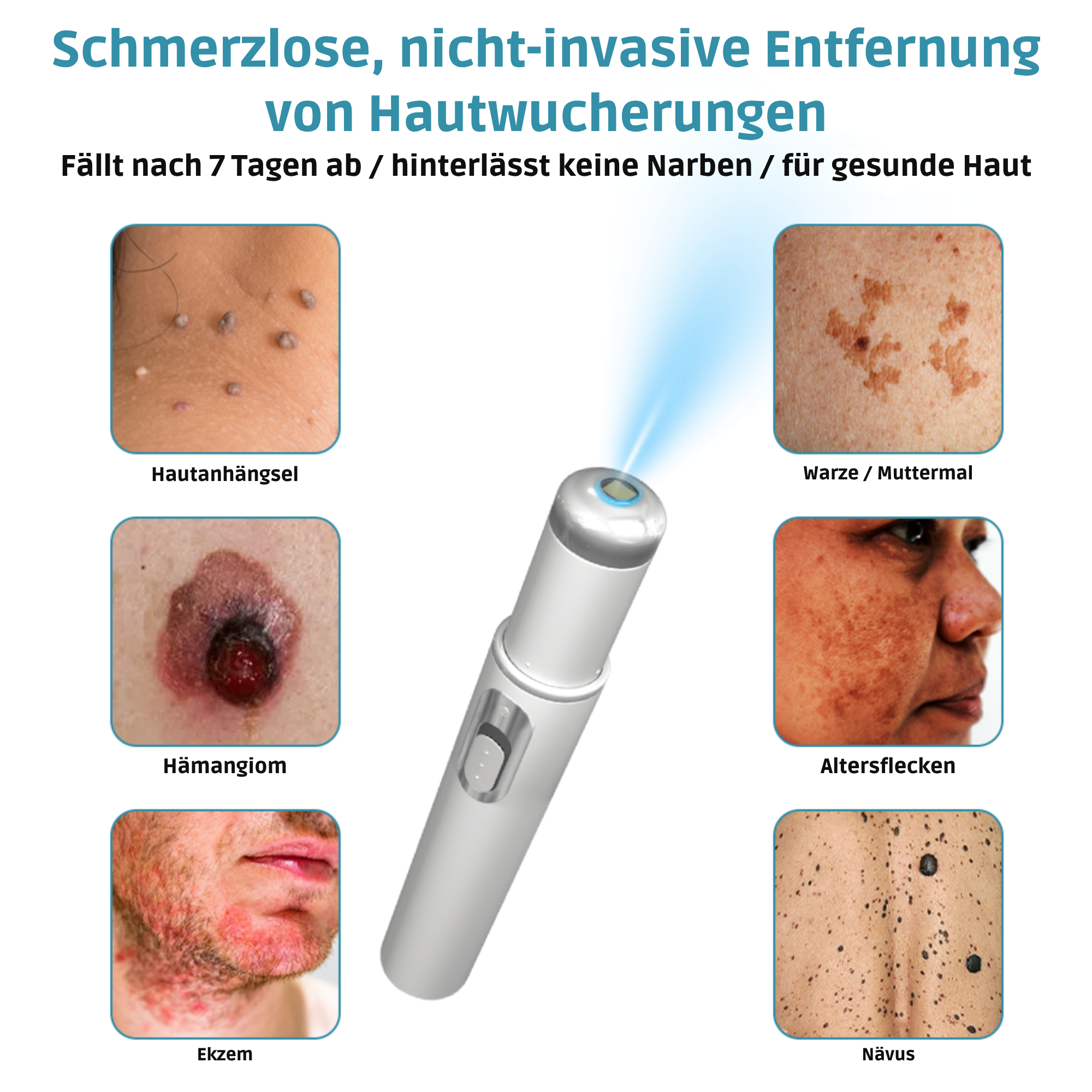 Klara® Schmerzfreier Laserstift zur Entfernung von Muttermalen und Warzen – Promax Edition
